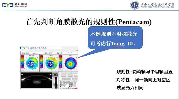 【规划未来】屈光术后散光晶体植入如何规划？