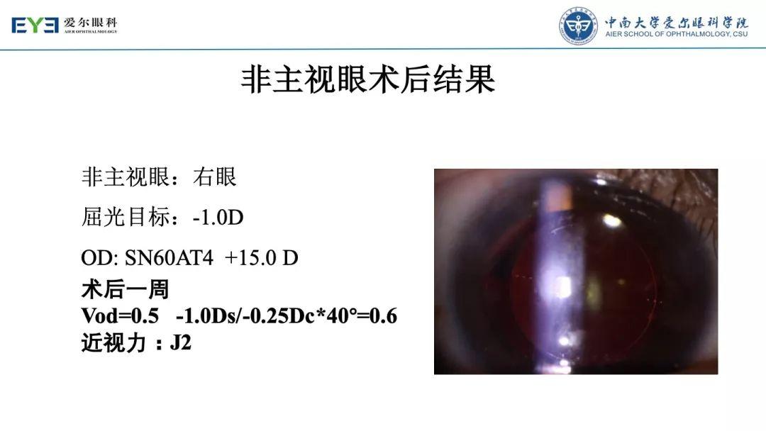 【规划未来】屈光术后散光晶体植入如何规划？