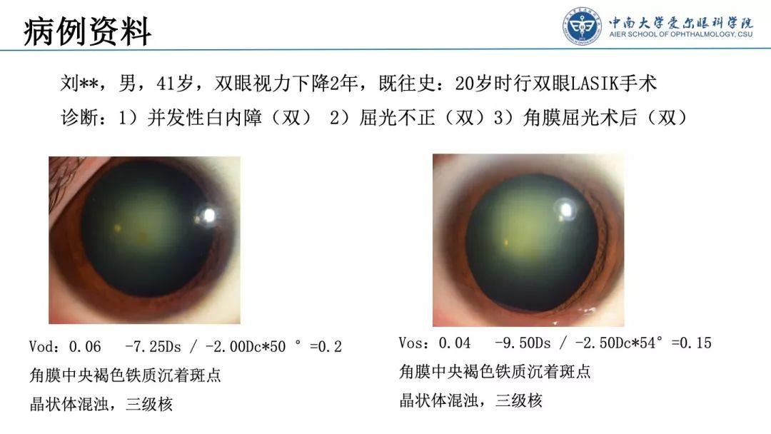 【规划未来】屈光术后散光晶体植入如何规划？