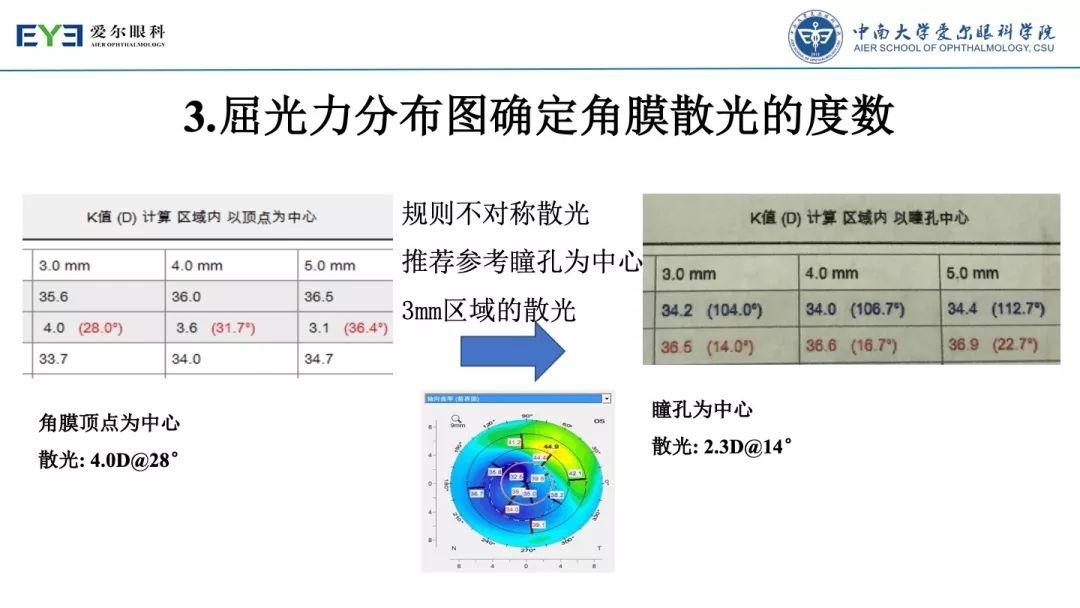 【规划未来】屈光术后散光晶体植入如何规划？