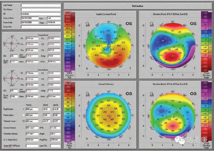 看完这10条，角膜地形图分析不再是难题！