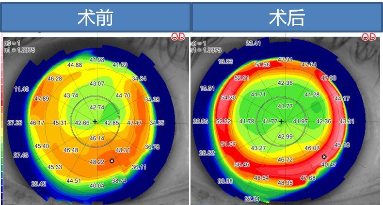 北京同仁医院翟长斌主任：阿玛仕个性化增效手术成功案例