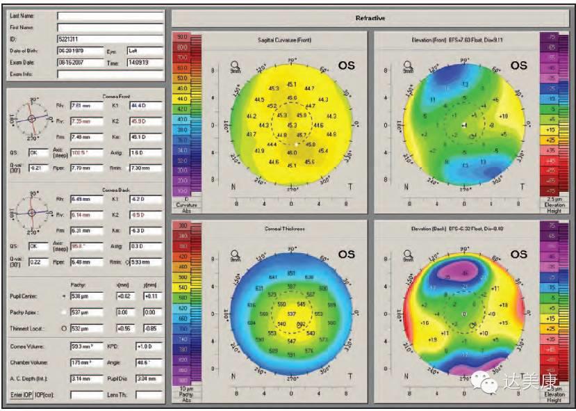 看完这10条，角膜地形图分析不再是难题！