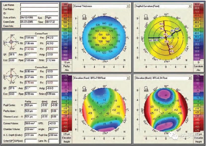 看完这10条，角膜地形图分析不再是难题！
