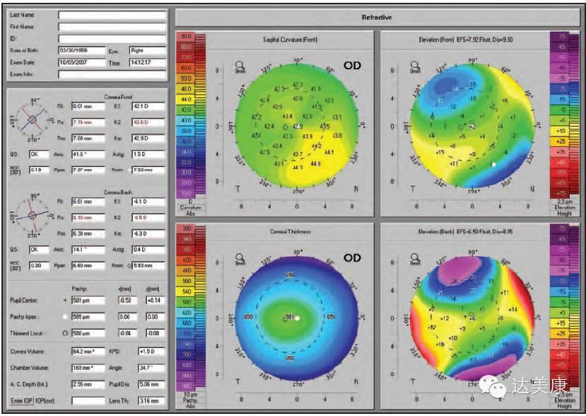 看完这10条，角膜地形图分析不再是难题！