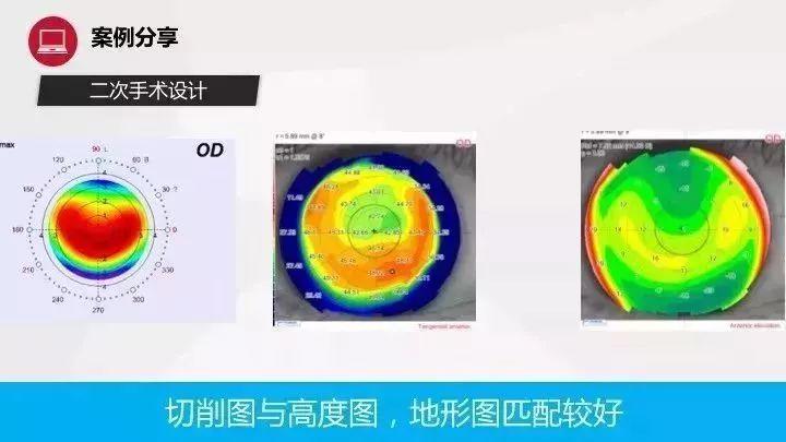 北京同仁医院翟长斌主任：阿玛仕个性化增效手术成功案例