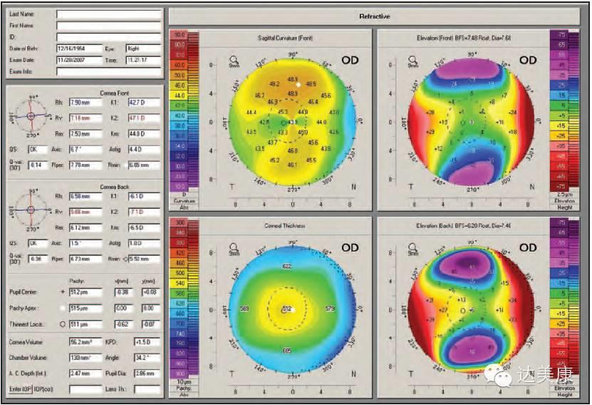 看完这10条，角膜地形图分析不再是难题！
