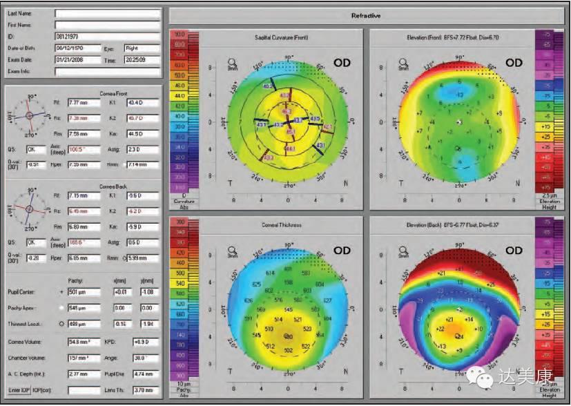 看完这10条，角膜地形图分析不再是难题！