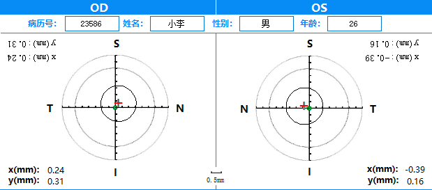 [更新2.1版]全飞秒Smile手术大Kappa角患者术中辅助应用程序