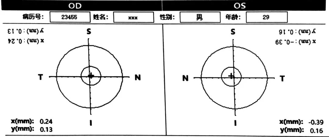 [更新2.1版]全飞秒Smile手术大Kappa角患者术中辅助应用程序