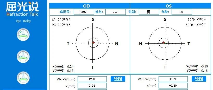 [更新2.1版]全飞秒Smile手术大Kappa角患者术中辅助应用程序-屈光说