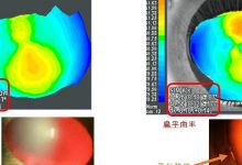 圆锥角膜与马凡悖论-一个大胆且合理的推论-屈光说