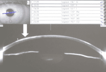 LASIK 术后单眼角膜混浊一例-屈光说