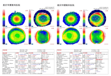 全平台全术式 rnMEL90 TPRK病例经验分享-屈光说