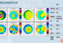 TransPRK联合CXL改善圆锥角膜不规则散光-屈光说