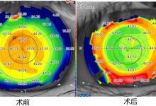 近视合并眼球震颤行臻选个性化手术案例分享-屈光说