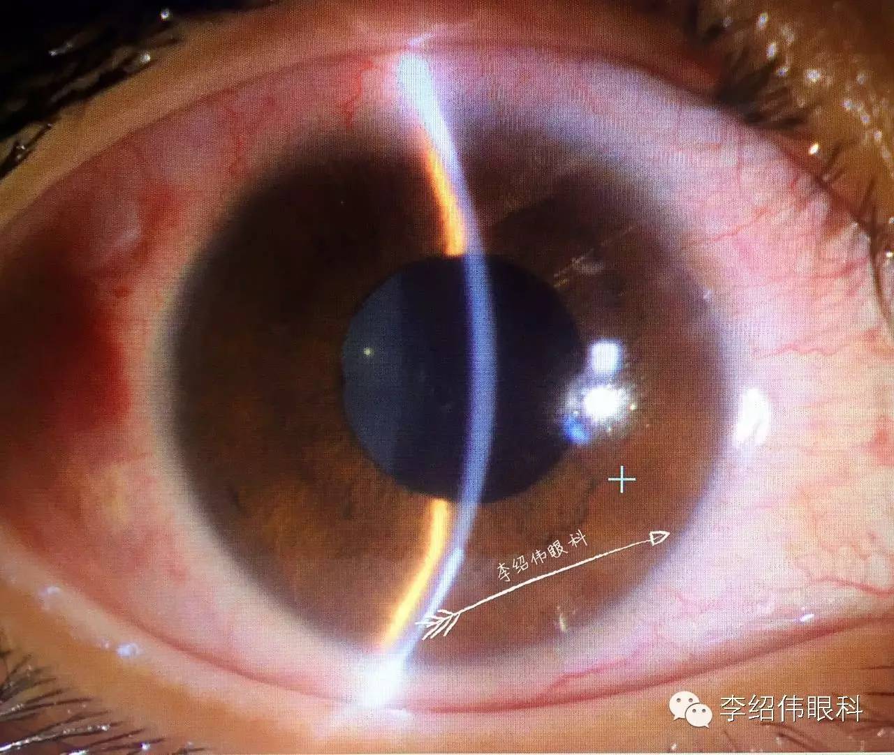 ICL术后高眼压处理经验总结-屈光说