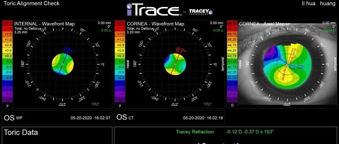 iTrace病例之iTrace在多焦散光IOL中的应用-屈光说