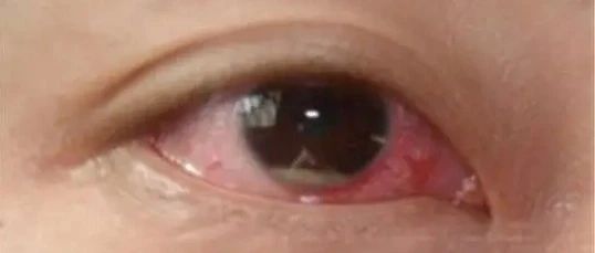 警惕新冠发热近视术后视力下降，以及新冠病毒性结膜炎-屈光说
